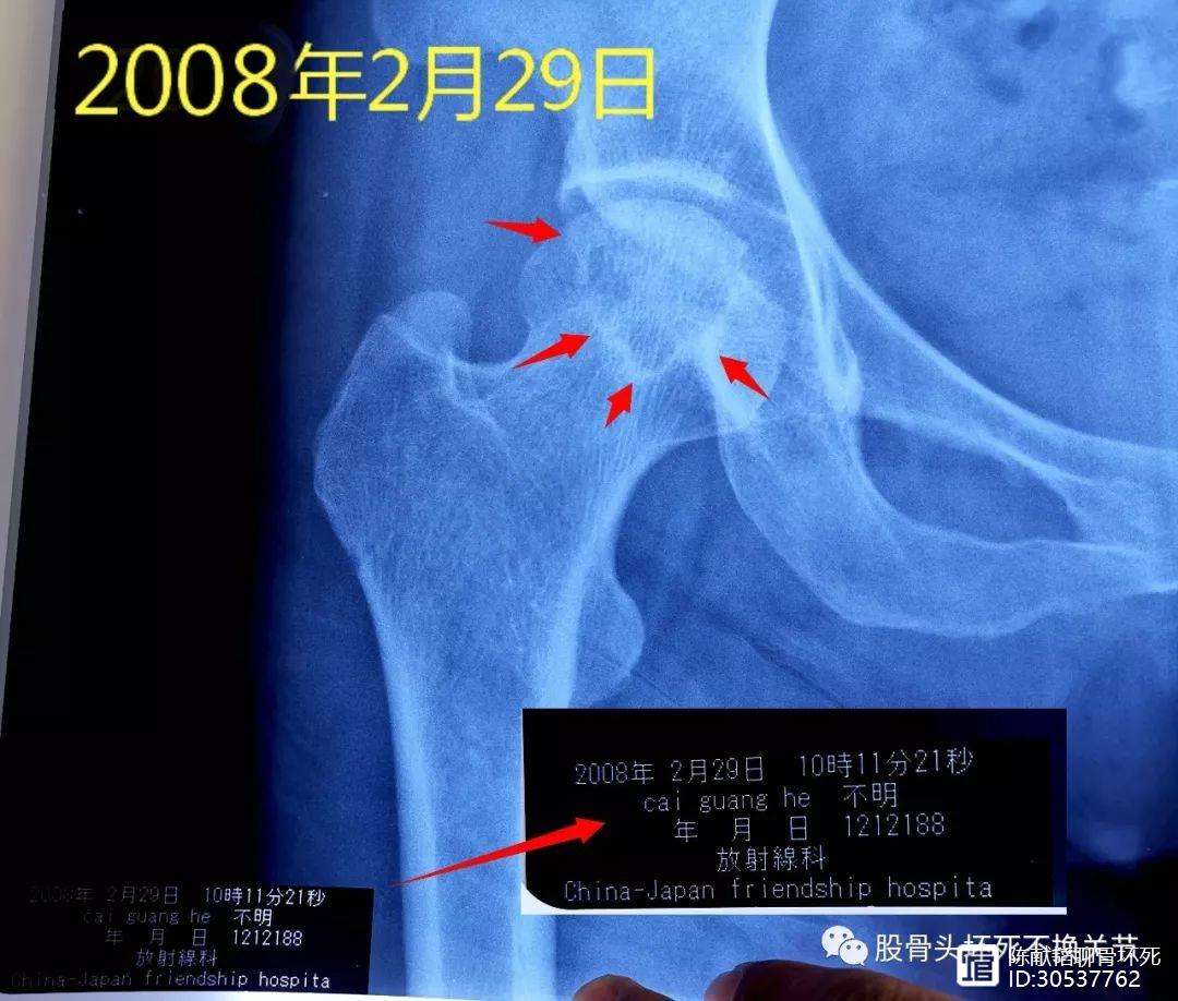 桂林人工骨头医保报销多少(人工骨头医保报销多少比例)